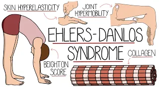 Ehlers Danlos Syndrome Explained Clearly