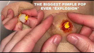 THE BIGGEST PUSS PIMPLE POP *SATISFYING*