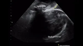 ISUOG practice guideline on intrapartum ultrasound