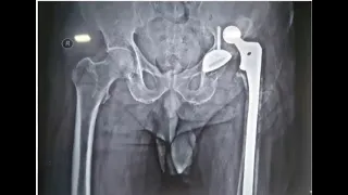 Dislocation after Total Hip Replacement