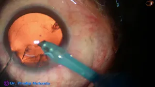 Totally unedited Phaco - Direct Chop-Hydroimplantation : Pradip Mohanta, 16th Feb, 2023