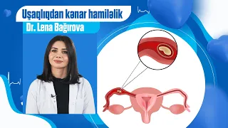 Uşaqlıqdan kənar hamiləliyin əlamətləri nələrdir?