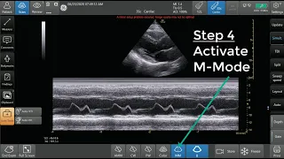 Ultrasound M-Mode Step by Step Guide. E Point Septal Separation (EPSS) Example