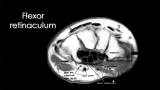 Imaging of Wrist joint Aug 2014   Dr Mamdouh Mahfouz In Arabic 720p