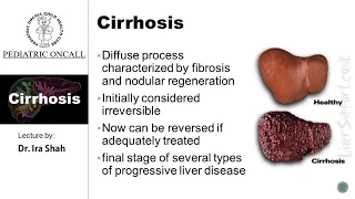 Dr. Ira Shah : What is Cirrhosis? | Pediatric Oncall