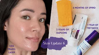 1 Year of Tretinoin, 2 Years of Dapsone, 6 Months of Spiro, & CO2 Fraxel Laser | SKIN UPDATE #6