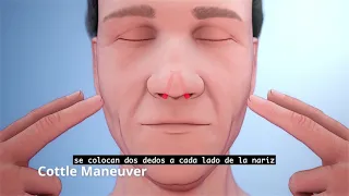 VivAer Patient Education Video with Spanish CC