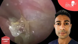 1,087 - Ear Tube Grommet Infected Dead Skin Peel