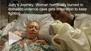 Woman Horrifically Burned due to Domestic Violence gets Inspiration to Keep Fighting