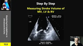 Step by Step Measuring Stroke Volume of MV, LV & RV