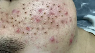 Remove Blackheads and Hidden Acne At Loan Nguyen Spa #293
