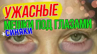 Как избавиться от мешков (синяков) под глазами? 👀   Блефаропластика (пластика век)