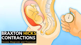 Braxton Hicks contractions, Causes, Signs and Symptoms, Diagnosis and Treatment.