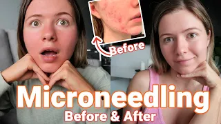 All About Microneedling (Vlog) | Before, After and Everything in Between (Healing Post-Acne Skin)