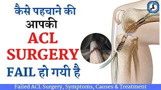 कैसे पहचाने की आपकी #ACL SURGERY FAIL हो गयी है ? Failed ACL Surgery, Symptoms, Causes & Treatment
