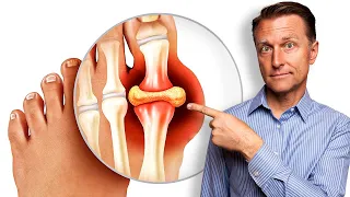 Remedy for Gout and Uric Acid - Straight From the Garden