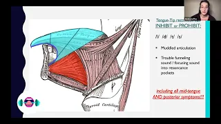 How Tongue Tie Affects Singing: Tongue Tied Singers