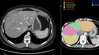 Anatomia de abdomen y pelvis por tomografia computada
