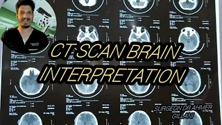 CT Scan Brain Plain Showing SDH EDH SAH Brain Contusion Subgaleal Hematoma And Frontal Fracture