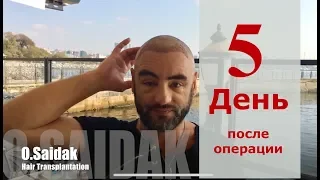 Пересадка Волос На Личном Опыте. 5-ый День После Операции.
