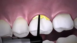 Periodontitis Management