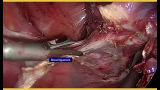 Laparoscopic hysterectomy with extensive adhesiolysis