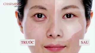 Bộ đôi trị nám chuyên sâu Anties Melasma Charming Skin, hiệu quả trị nám sạch sâu đến 95%