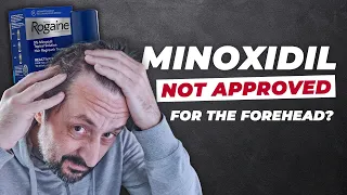 Does Minoxidil Work for Frontal Baldness