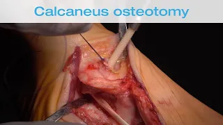 calcaneal osteotomy - acquired flatfoot with FDL tendon transfer