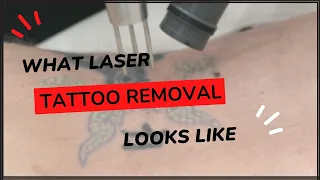 What Laser Tattoo Removal Looks Like