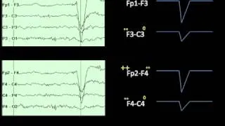 Eye Movements on EEG