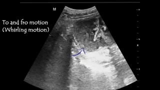 Emergency Point of Care Ultrasound In Small Bowel Obstruction; Case 1