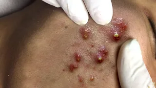 Suri Job #657: Awesome Hidden Acne Extraction