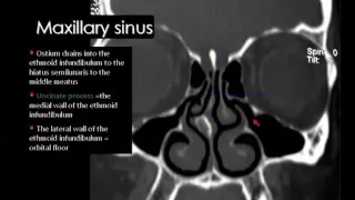 Imaging Paranasal sinuses   DRE 3   Dr Mamdouh Mahfouz 720p