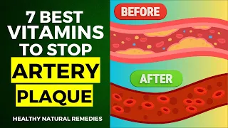 7 Best Vitamins To Stop Artery Plaque