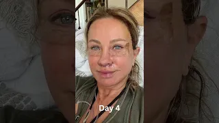 Day-by-day Facelift Recovery and Healing Process!