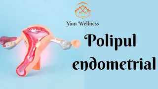 S2. Ep 20 - Polipul Endometrial | Uterin | Infertilitate | Cum se manifestă şi cum se tratează ?