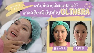 รีวิวทำ Ulthera  ยกกระชับหน้าเรียว เตรียมตัวเป็นเเจ้าสาว | Bb STORY