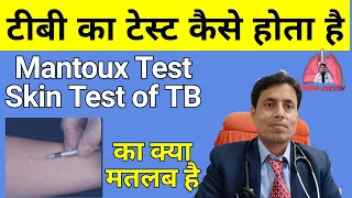 Mantoux test // PPD // Tuberculin Test // Skin Test for TB Diagnosis by Dr Sanjay Chest Specialist