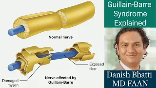 Guillain-Barre Syndrome | Causes | Symptoms | A Brief Overview