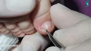 7-MONTH-OLD BABY: INGROWN TOENAIL (with English subtitles)