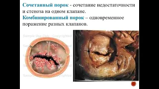 2 06 22 Торунова АМ Приобретенные пороки сердца