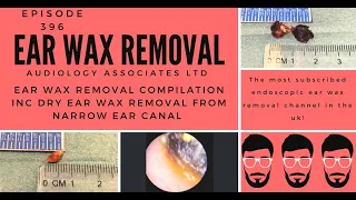 EAR WAX REMOVAL COMPILATION INC DRY EAR WAX REMOVAL FROM NARROW EAR CANAL - EP 396