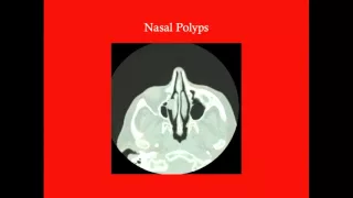 Nasal Cavity - CRASH! Medical Review Series