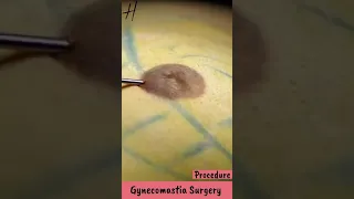 ✅ Gynecomastia Surgery Procedure   #shorts