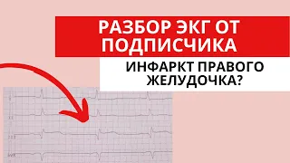 Разбор ЭКГ от подписчика. Инфаркт правого желудочка? (Острый коронарный синдром)