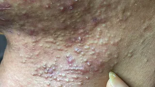 Acne Treatment For "Hung" (P8) | Điều Trị Mụn Cho Hùng (P8) -  SacDepSpa#203