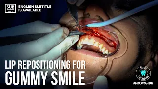 Lip Repositioning Surgery For Gummy Smile  (Case Study) - Narrated by Dr. Omer Karaaslan