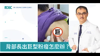 背部長出巨型粉瘤Epidermoid Cyst怎麼辦|微創抽吸術|最常見的皮膚良性腫瘤【表皮囊腫(粉瘤)】