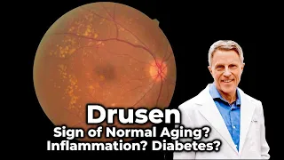 Drusen - Sign of Normal Aging? Inflammation? Diabetes?